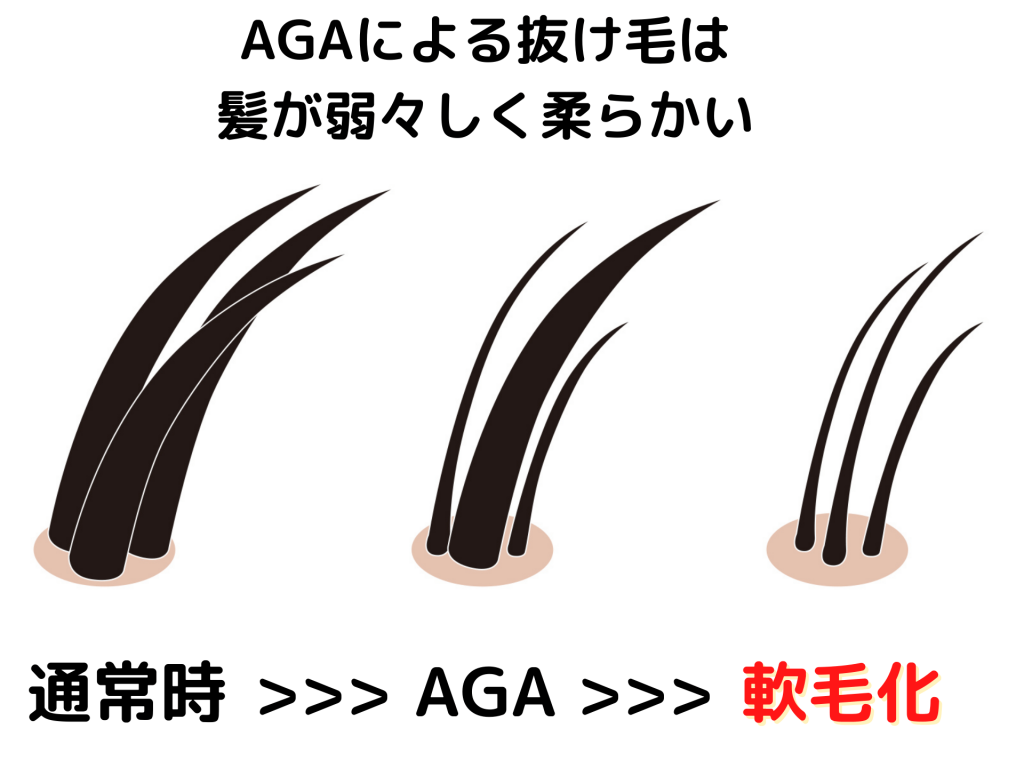 抜け毛　AGA