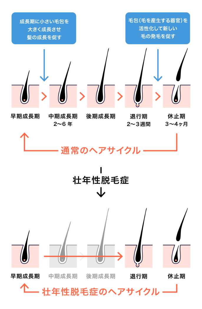 壮年製脱毛症のヘアサイクル