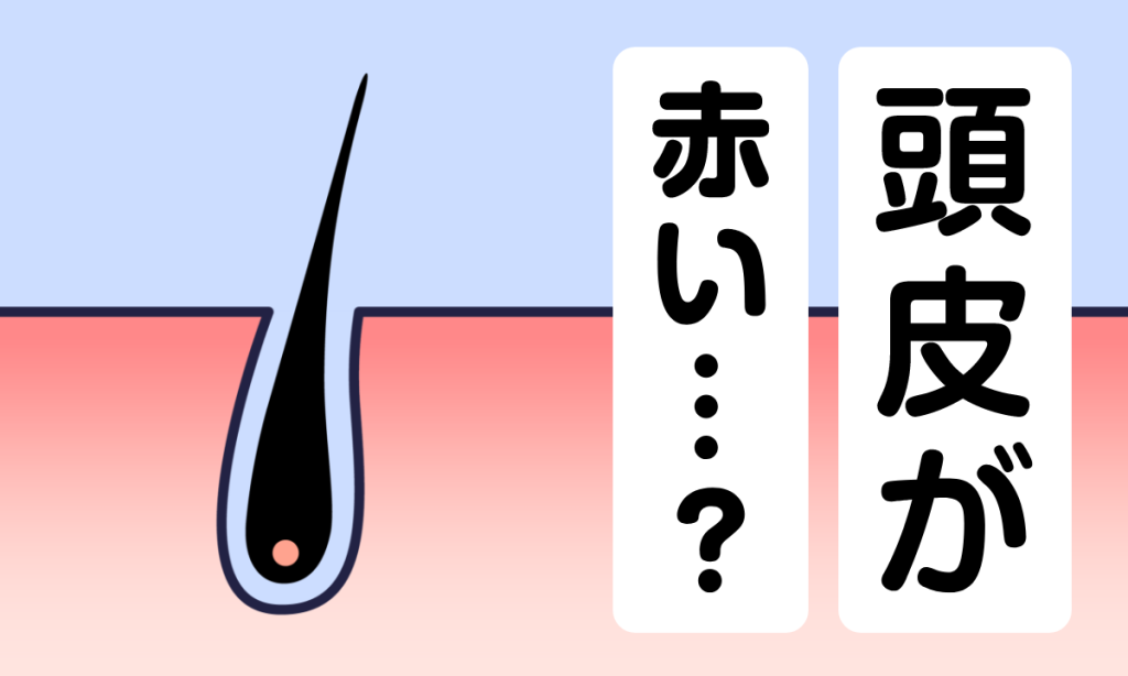 頭皮が赤いのは薄毛のサイン？湿疹やかゆみなどを感じる原因と対処方法