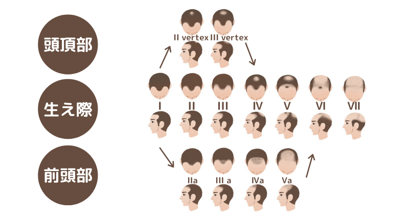 薄毛の分類