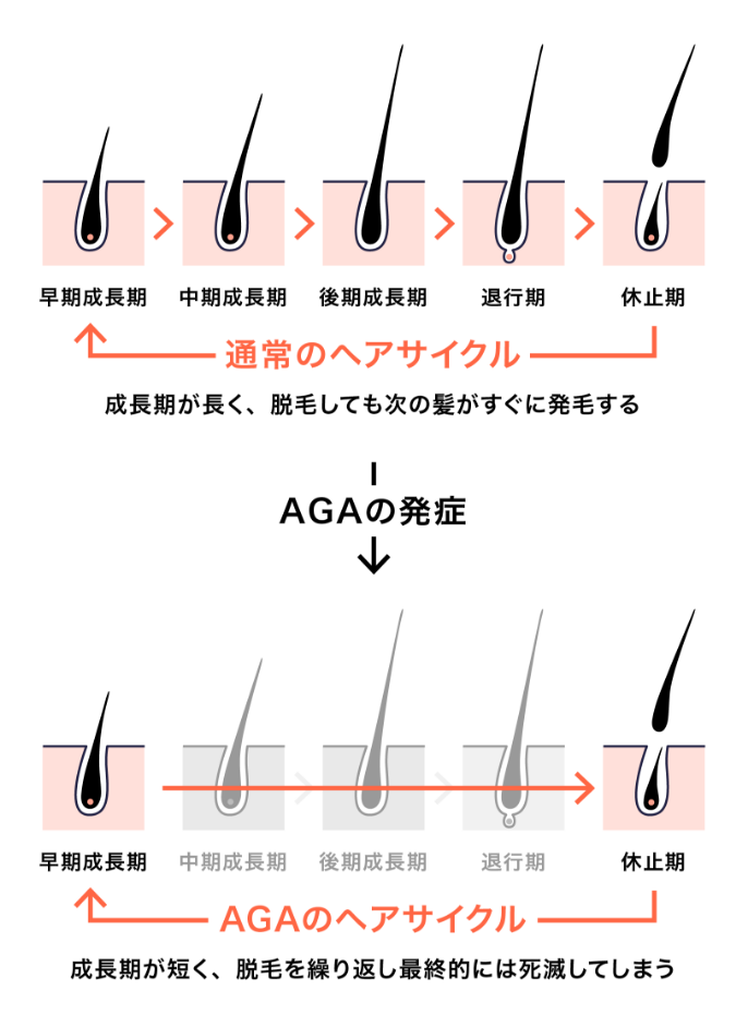 AGAのヘアサイクル