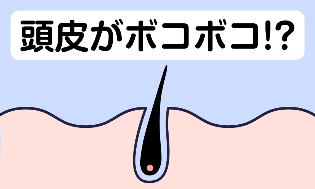 頭皮がボコボコになるのは頭皮湿疹？10個の原因を紹介！改善方法も